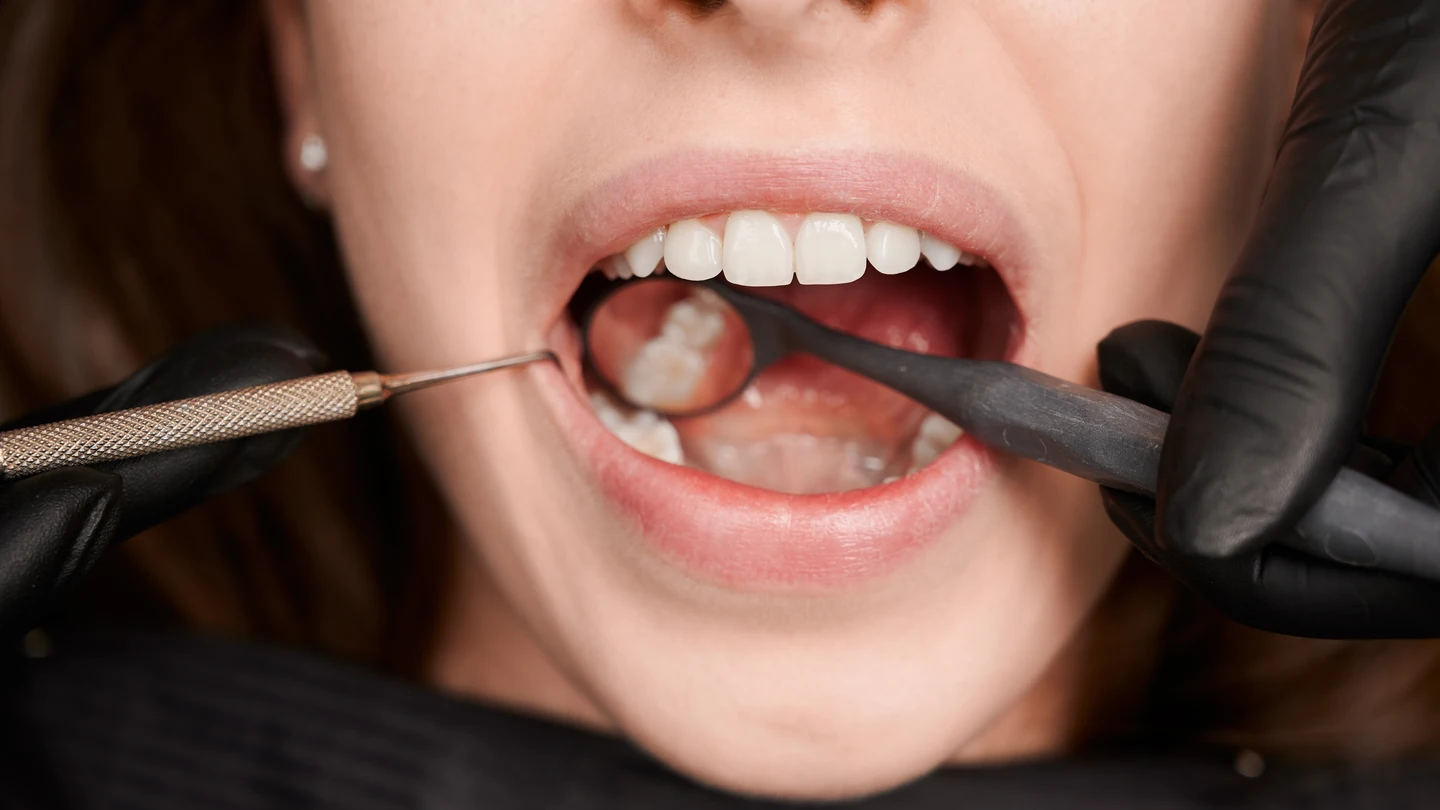 Cuando tus encías se inflaman y sangran... Así afecta la periodontitis a tu corazón y salud cardiovascular Cuando tus encías se inflaman y sangran... Así afecta la periodontitis a tu corazón y salud cardiovascular