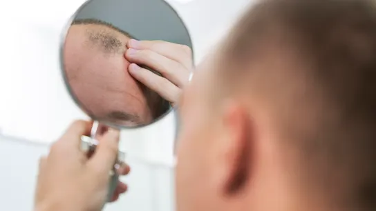 Ya está disponible en España un fármaco "revolucionario" para tratar la alopecia areata (el segundo tipo más común de calvicie) Ya está disponible en España un fármaco "revolucionario" para tratar la alopecia areata (el segundo tipo más común de calvicie)