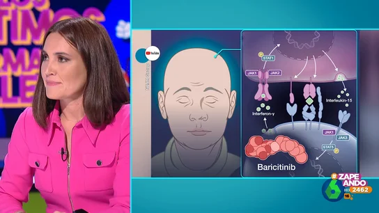 ¿En qué se diferencian la alopecia areata de la androgénica? Boticaria García lo aclara ¿En qué se diferencian la alopecia areata de la androgénica? Boticaria García lo aclara