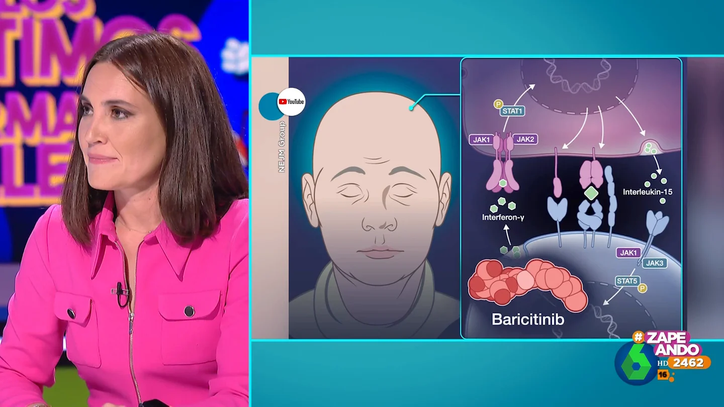 ¿En qué se diferencian la alopecia areata de la androgénica? Boticaria García lo aclara ¿En qué se diferencian la alopecia areata de la androgénica? Boticaria García lo aclara
