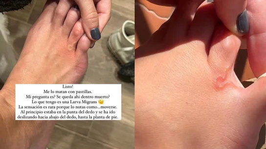 ¿Qué es larva migratoria, el gusano que crece y se mueve bajo la piel de la influencer Lucía Pombo? ¿Qué es larva migratoria, el gusano que crece y se mueve bajo la piel de la influencer Lucía Pombo?