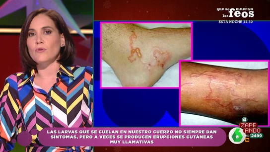 ¿Cómo detectamos que tenemos una larva en nuestro cuerpo? Boticaria García aclara que no suelen producir síntomas ¿Cómo detectamos que tenemos una larva en nuestro cuerpo? Boticaria García aclara que no suelen producir síntomas