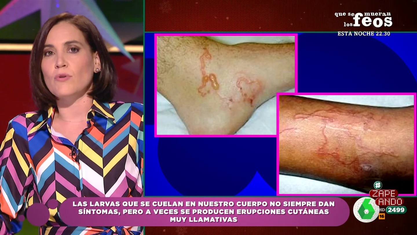 ¿Cómo detectamos que tenemos una larva en nuestro cuerpo? Boticaria García aclara que no suelen producir síntomas ¿Cómo detectamos que tenemos una larva en nuestro cuerpo? Boticaria García aclara que no suelen producir síntomas