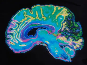 MRI de un cerebro humano MRI de un cerebro humano
