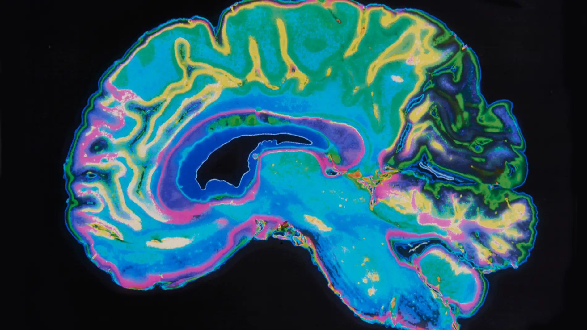 MRI de un cerebro humano