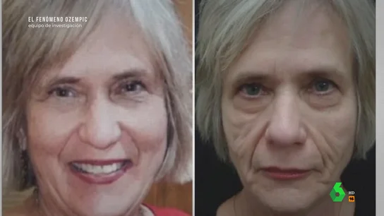 Así es la 'cara de Ozempic', el efecto secundario más común entre quienes utilizan este medicamento para adelgazar Equipo de Investigación analiza el efecto secundario más común de Ozempic cuando se utiliza como fármaco para adelgazar y visita una clínica que lo trata. En este vídeo, explican el tiempo que dura el tratamiento y su precio.