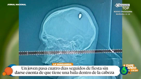 Un chico descubre que tiene una bala en la cabeza después de pasar cuatro días seguidos de fiesta Un chico descubre que tiene una bala en la cabeza después de pasar cuatro días seguidos de fiesta