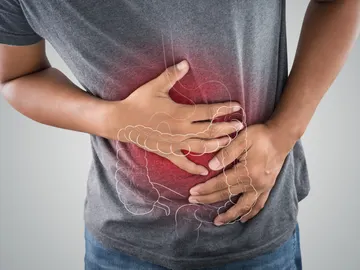 Cáncer colon Cáncer colon