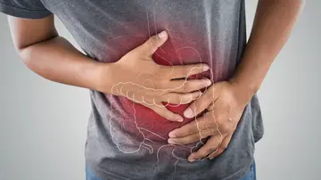 Cáncer colon Cáncer colon