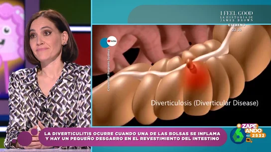 Boticaria García desvela quiénes presentan más riesgos de sufrir diverticulitis Boticaria García desvela quiénes presentan más riesgos de sufrir diverticulitis