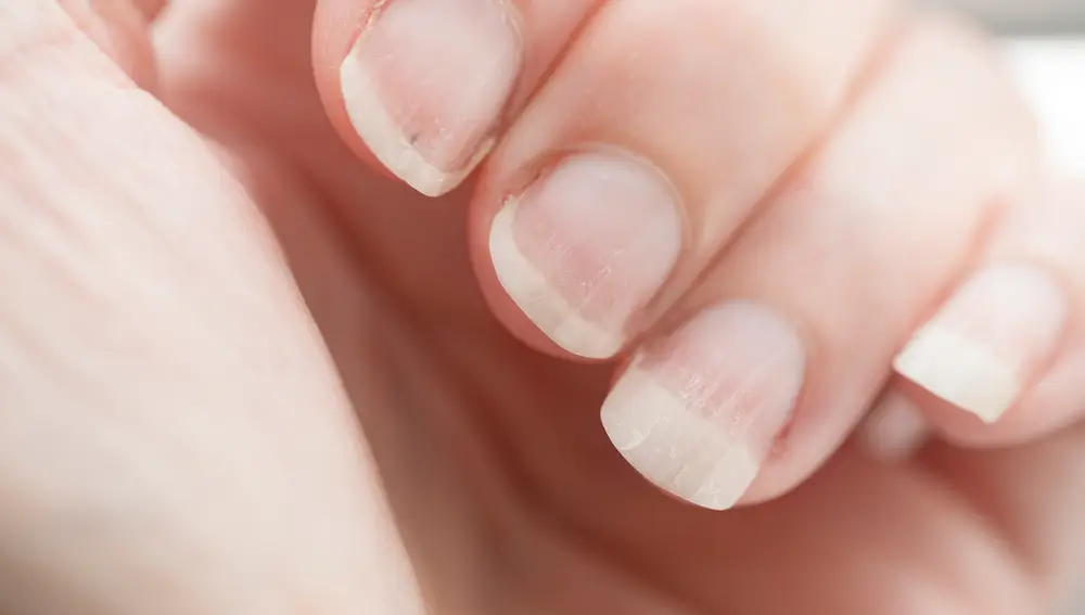 Uñas estropeadas Uñas estropeadas