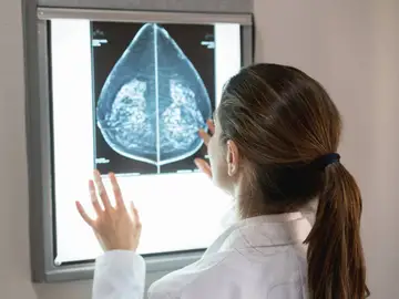 Una doctora observando una imagen de cáncer de mama. Una doctora observando una imagen de cáncer de mama.