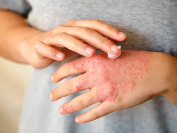 Dermatitis atópica Dermatitis atópica