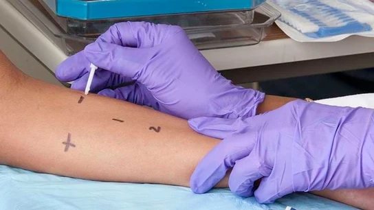 Una prueba de alergia. Una prueba de alergia.