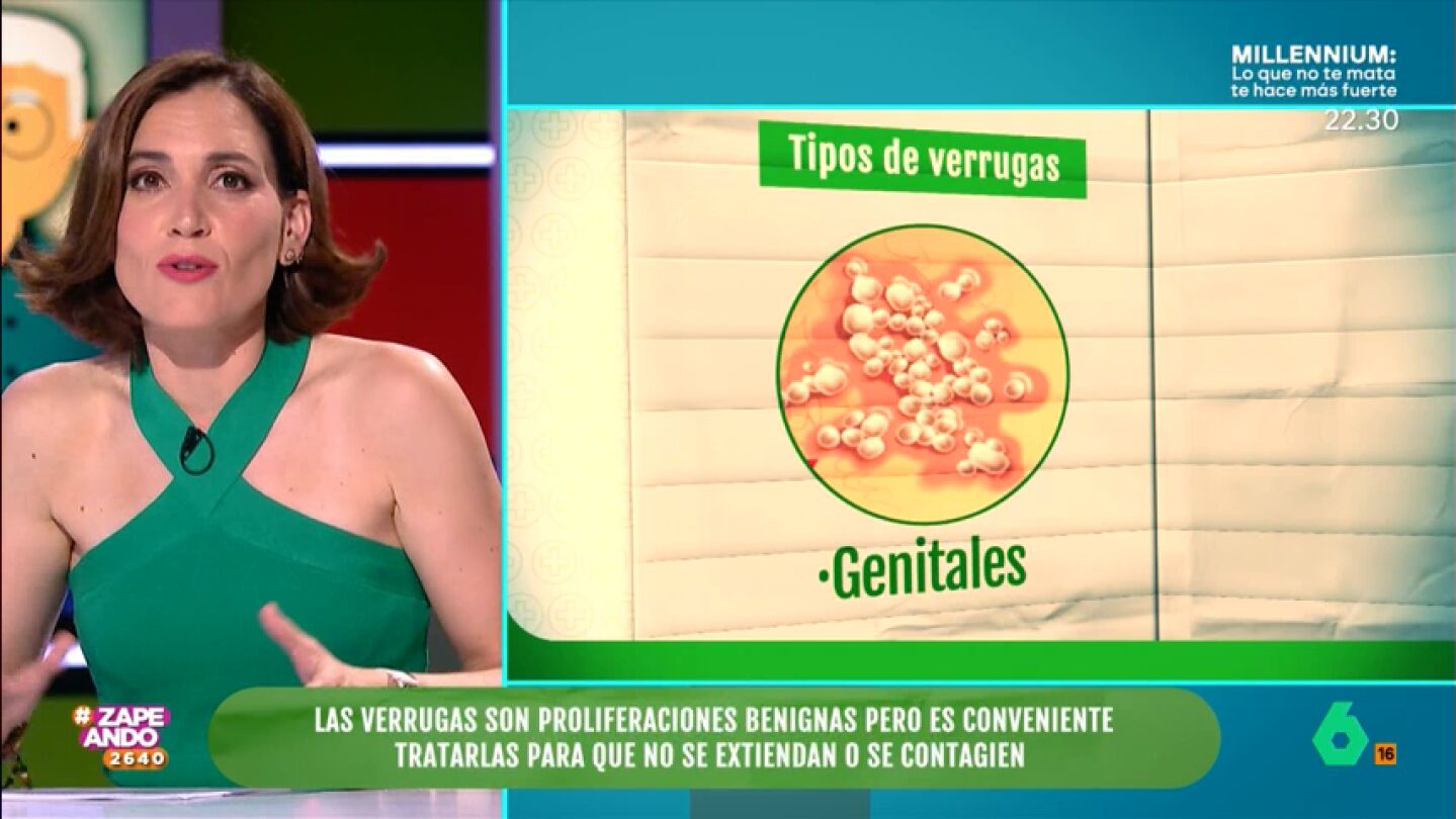 Boticaria Garc&iacute;a ense&ntilde;a a los zapeadores a diferenciar los tipos de verrugas