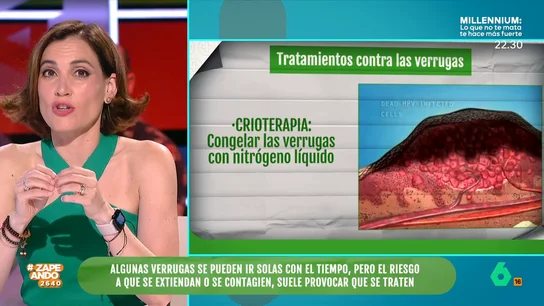 Boticaria García explica como son los tratamientos para eliminar las verrugas Boticaria García explica como son los tratamientos para eliminar las verrugas