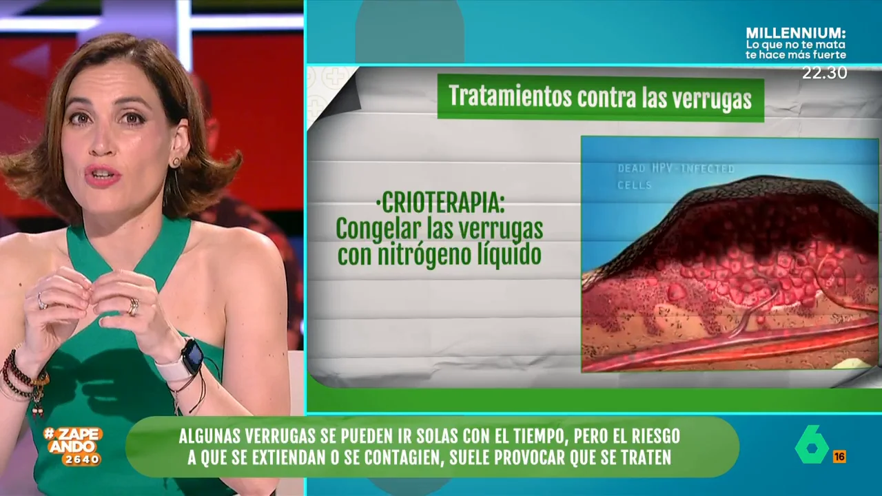 Boticaria García explica como son los tratamientos para eliminar las verrugas