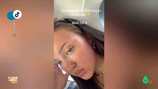 Una joven se pasa tomando el sol y termina con la frente abollada: "Por menos hay sitios que se declaran zona catastrófica" La chica de Florida no usó protección solar lo que tuvo consecuencias nefastas para su piel. La chica, en lugar de ir al médico, decidió que lo mejor era mostrar sus quemaduras en redes sociales.