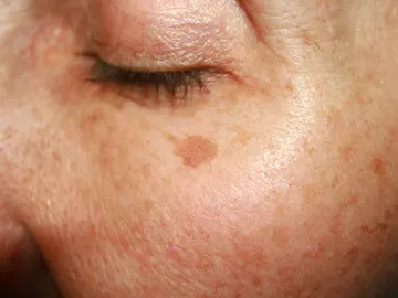 Manchas en la piel Manchas en la piel