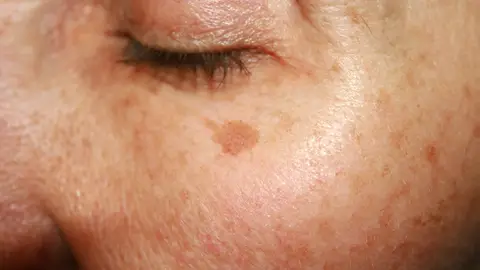 Manchas en la piel Manchas en la piel