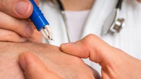 Quitar una garrapata con pinzas