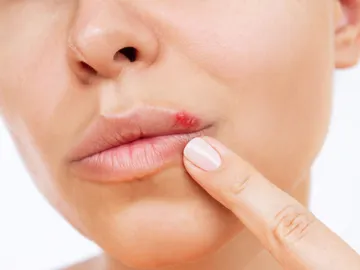 Una mujer con herpes labial Una mujer con herpes labial