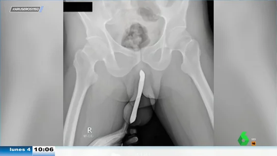 Un hombre de 43 años se somete a una cirugía para extraer un cepillo de dientes de su pene Un hombre de 43 años se somete a una cirugía para extraer un cepillo de dientes de su pene
