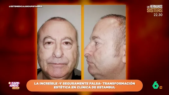 Una clínica turca se hace viral por una transformación estética increíble e inverosímil Una clínica turca se hace viral por una transformación estética increíble e inverosímil