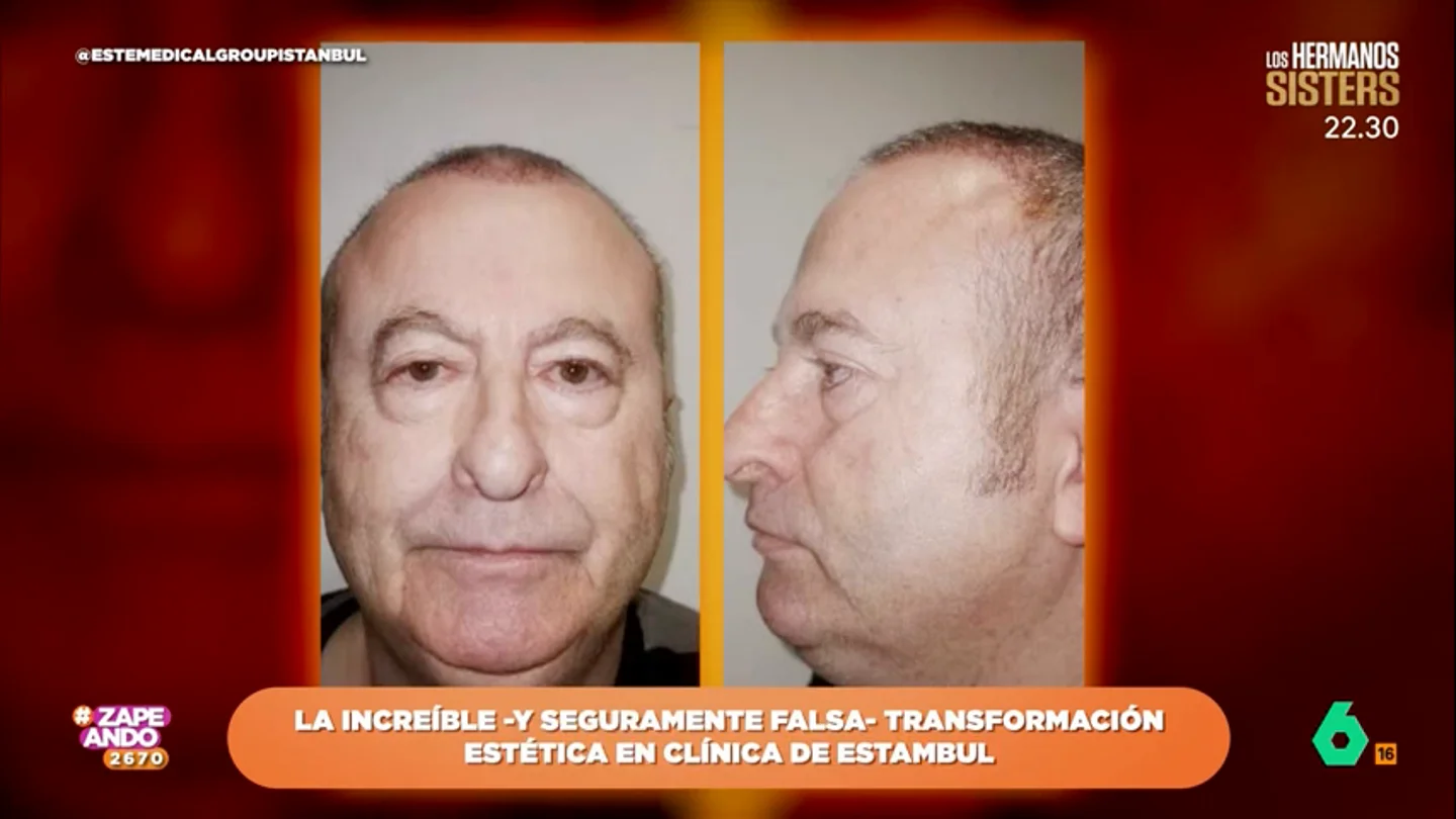 Una clínica turca se hace viral por una transformación estética increíble e inverosímil Una clínica turca se hace viral por una transformación estética increíble e inverosímil