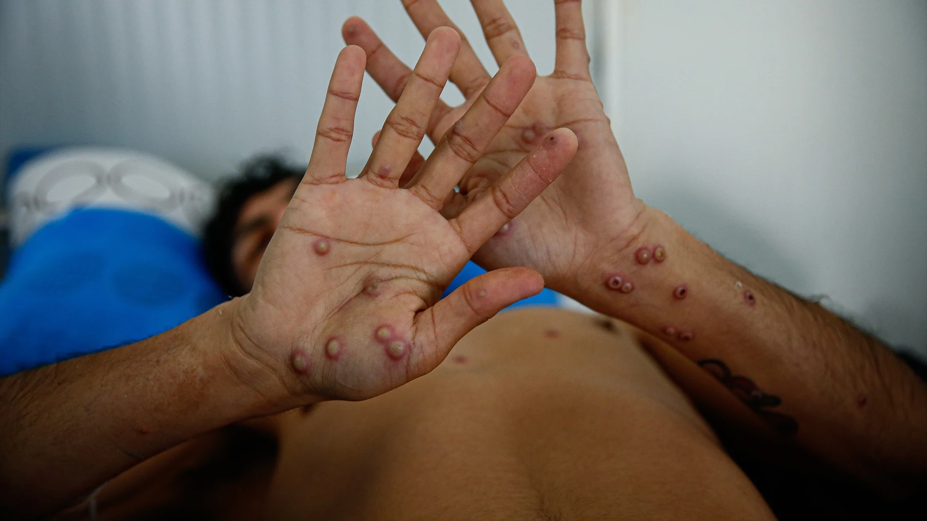 Cantabria detecta el primer caso de viruela del mono