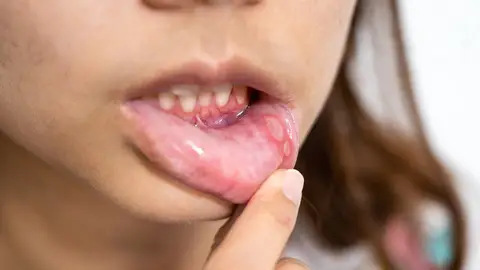 Llagas en el labio inferior Llagas en el labio inferior