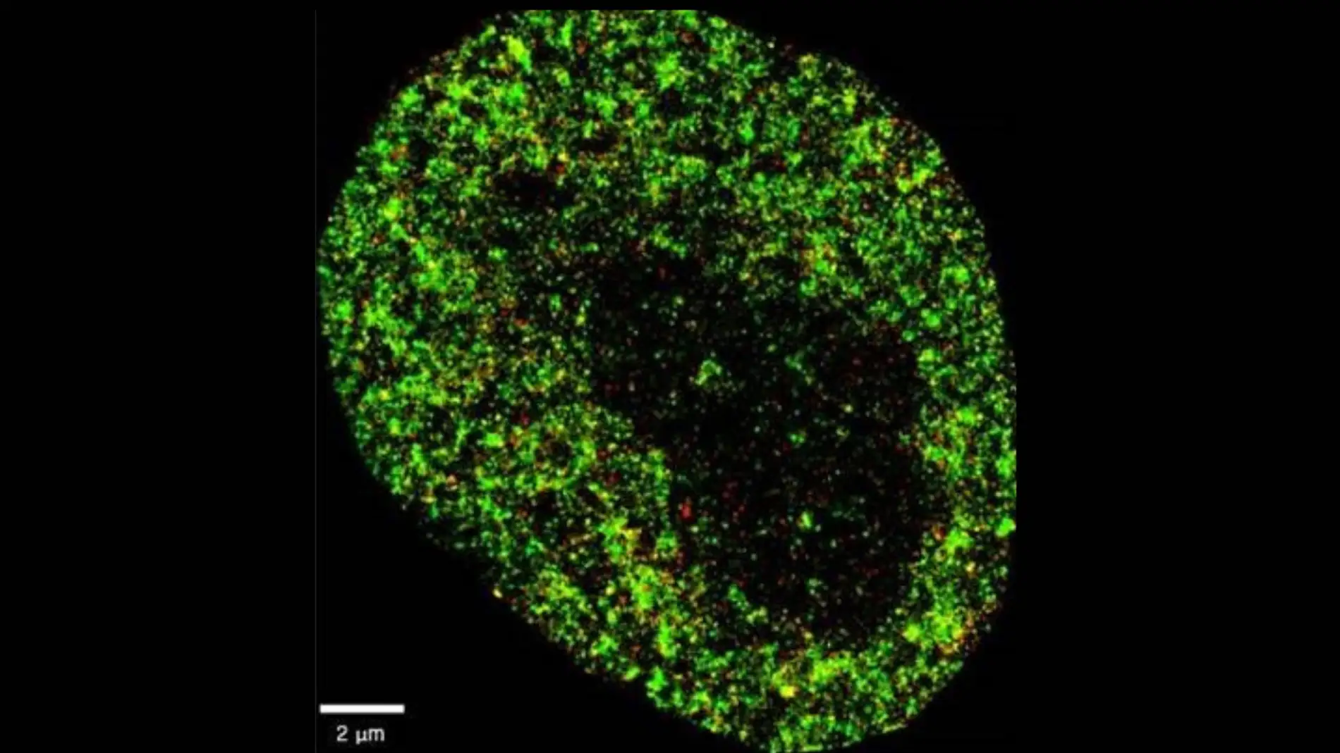 Imagen microscópica de una célula cancerosa Imagen microscópica de una célula cancerosa