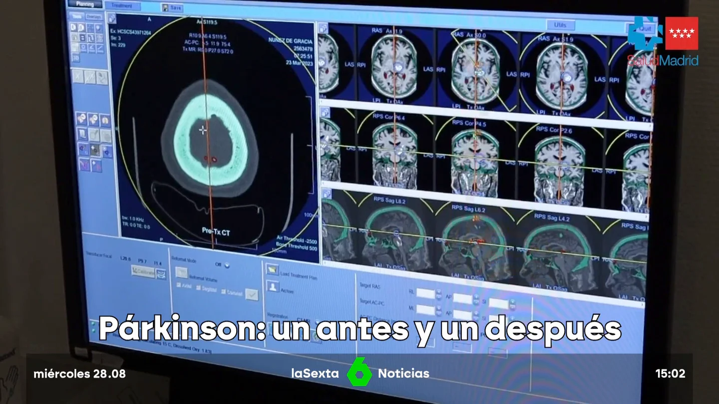 Párkinson: antes y después Párkinson: antes y después