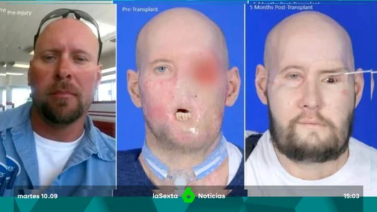 Así ha quedado (un año después) el primer trasplante completo de ojo y de cara parcial del mundo Así ha quedado (un año después) el primer trasplante completo de ojo y de cara parcial del mundo