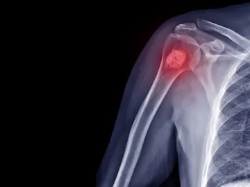 Cáncer de huesos Cáncer de huesos