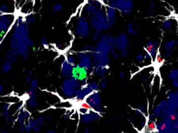 Células en torno a una metástasis cerebral