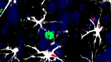 Células en torno a una metástasis cerebral Células en torno a una metástasis cerebral