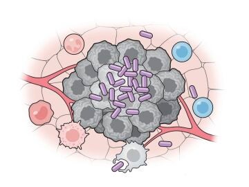 Células bacterianas artificiales (púrpura) activan varias partes del sistema inmunitario para atacar a las células tumorales (gris)