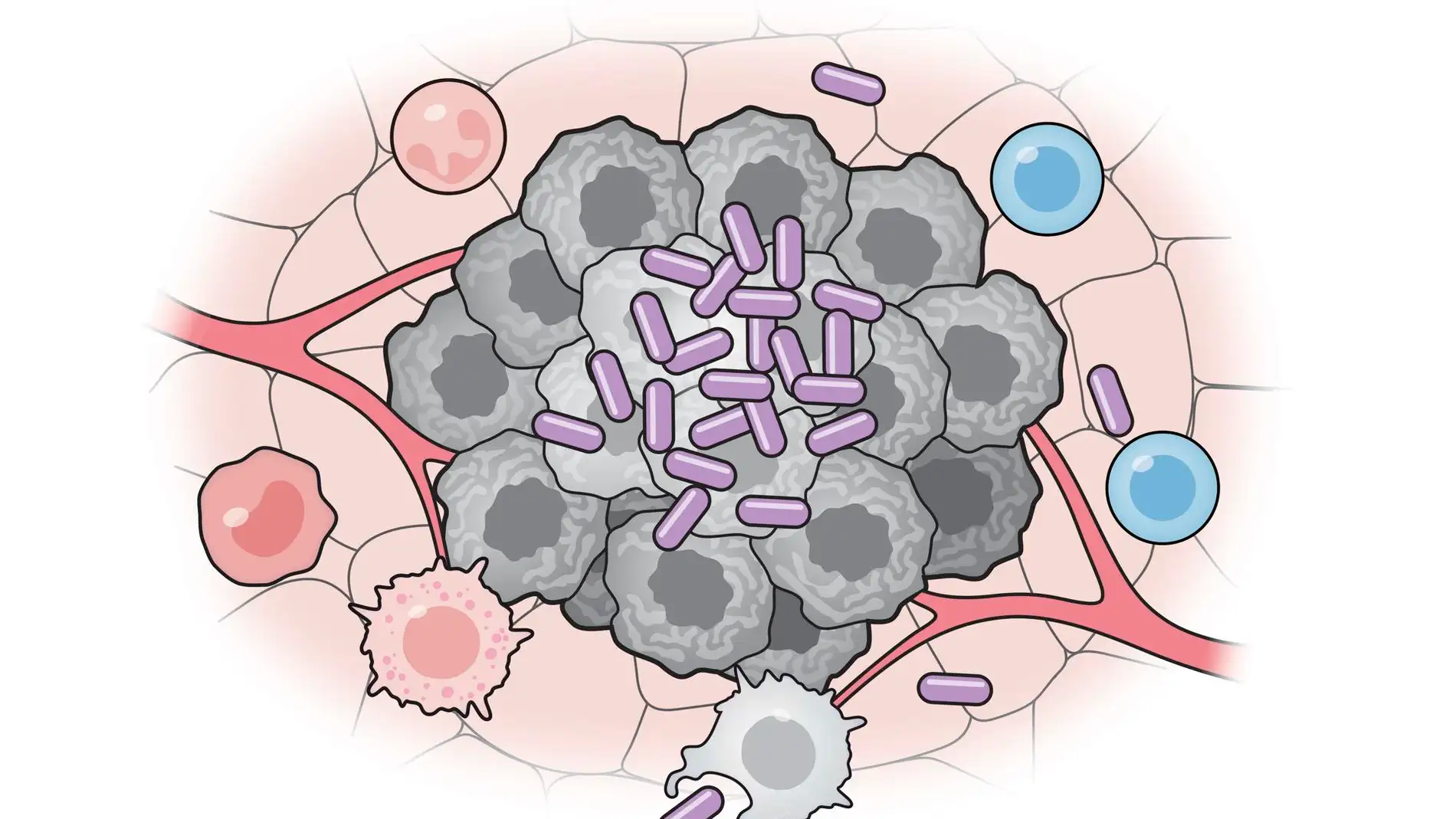 Células bacterianas artificiales (púrpura) activan varias partes del sistema inmunitario para atacar a las células tumorales (gris) Células bacterianas artificiales (púrpura) activan varias partes del sistema inmunitario para atacar a las células tumorales (gris)
