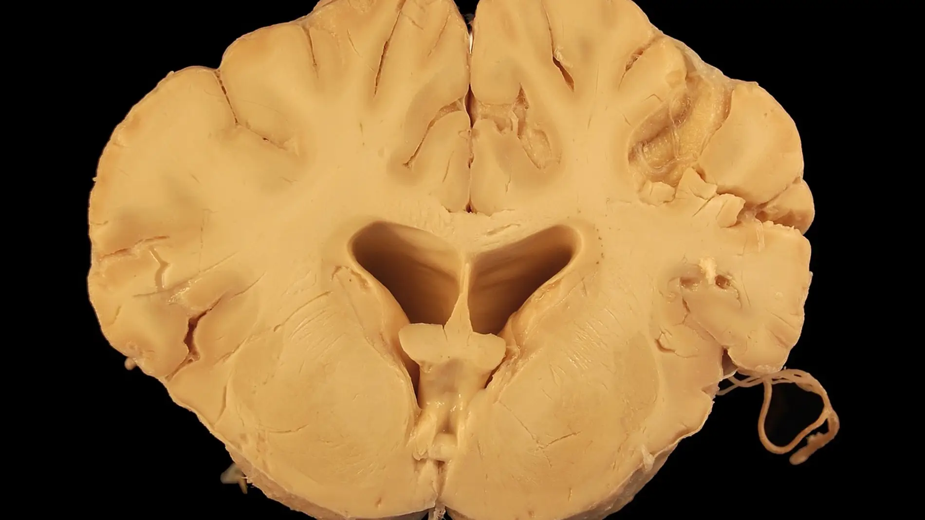 Cerebro Cerebro