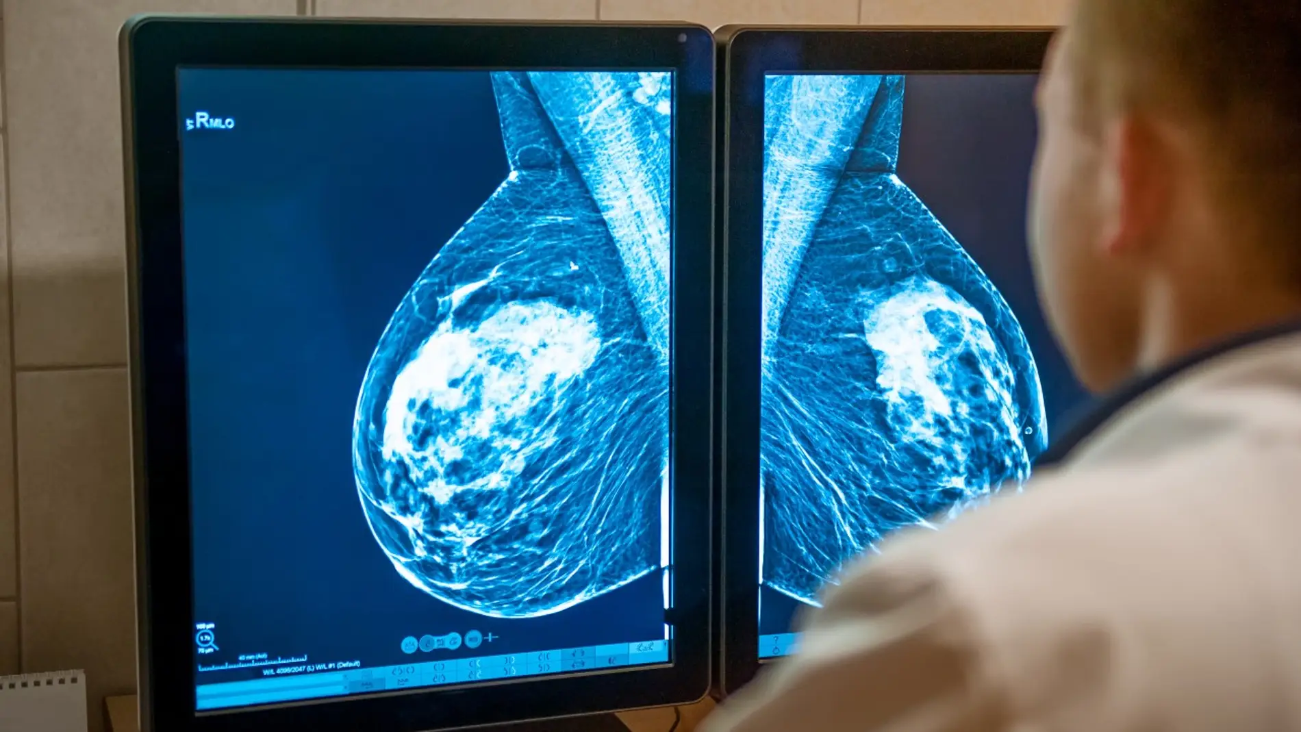 Las tasas de supervivencia a cinco años del cáncer de mama alcanzan ya el 86 % Las tasas de supervivencia a cinco años del cáncer de mama alcanzan ya el 86 %