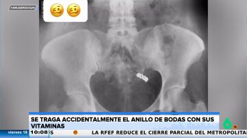 Una joven se traga de forma accidental su anillo de bodas con las vitaminas y muestra la radiografía a sus seguidores