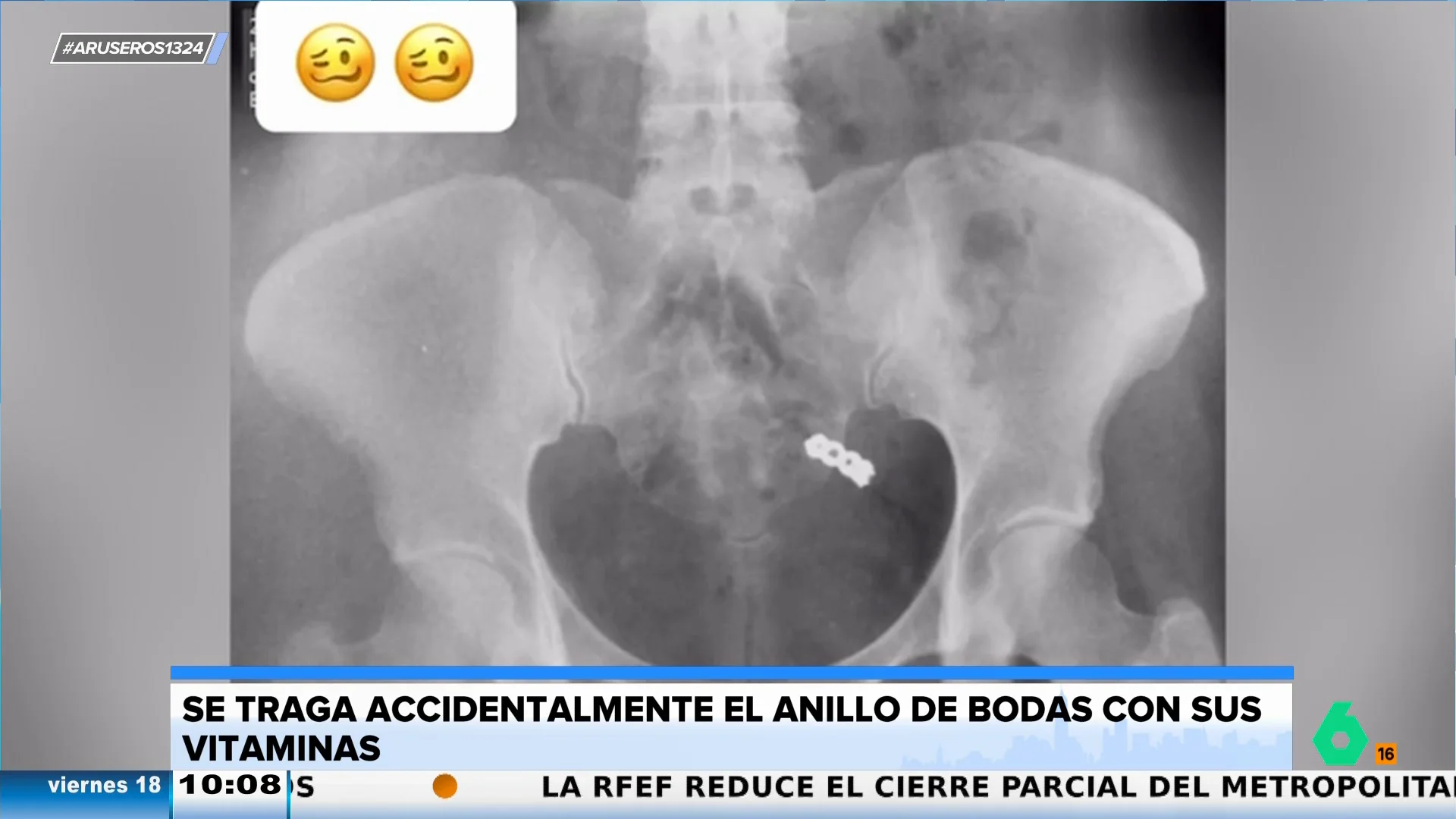 Una joven se traga de forma accidental su anillo de bodas con las vitaminas y muestra la radiografía a sus seguidores