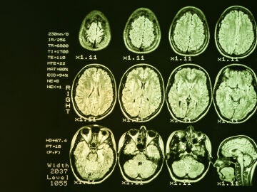 Imagen de resonancia magnética de un cerebro humano