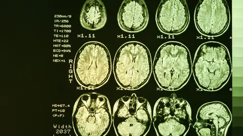 Imagen de resonancia magnética de un cerebro humano Imagen de resonancia magnética de un cerebro humano