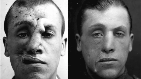 El sargento Sidney Beldman resultó herido en la batalla de Passchendaele El sargento Sidney Beldman resultó herido en la batalla de Passchendaele
