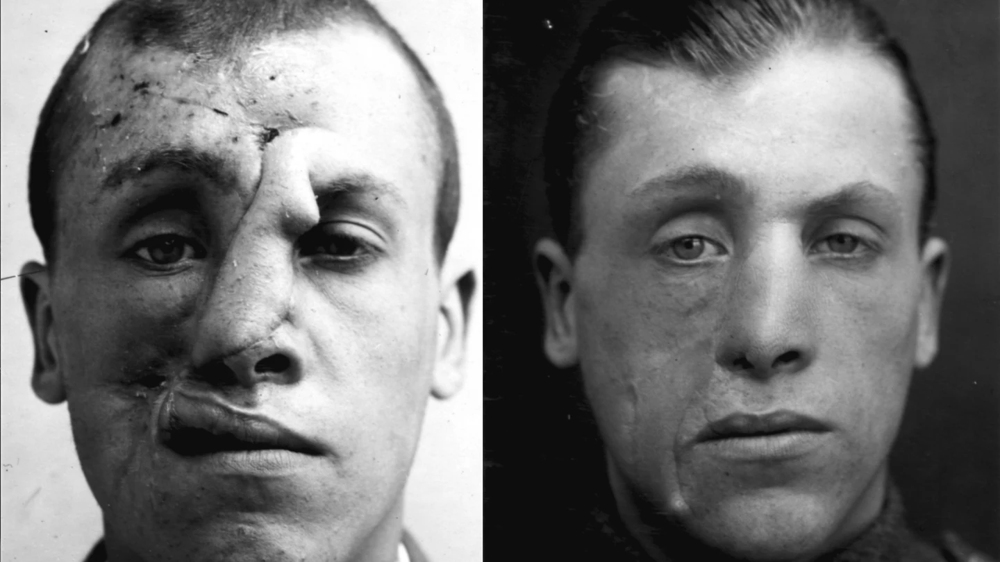 El sargento Sidney Beldman resultó herido en la batalla de Passchendaele El sargento Sidney Beldman resultó herido en la batalla de Passchendaele