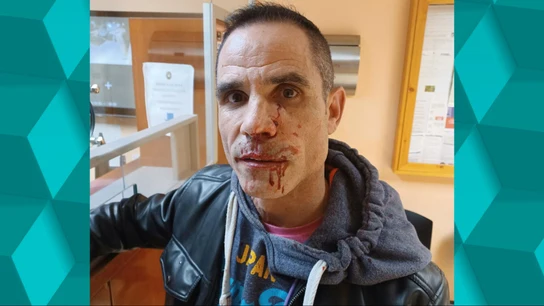 Oriol, dueño de un bar de copas, víctima de una agresión homófoba Oriol, dueño de un bar de copas, víctima de una agresión homófoba