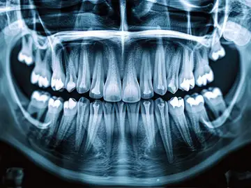 implantes de titanio biocomplatibles implantes de titanio biocomplatibles