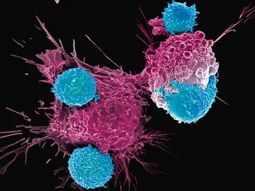 Las células CAR T atacan el cáncer Las células CAR T atacan el cáncer
